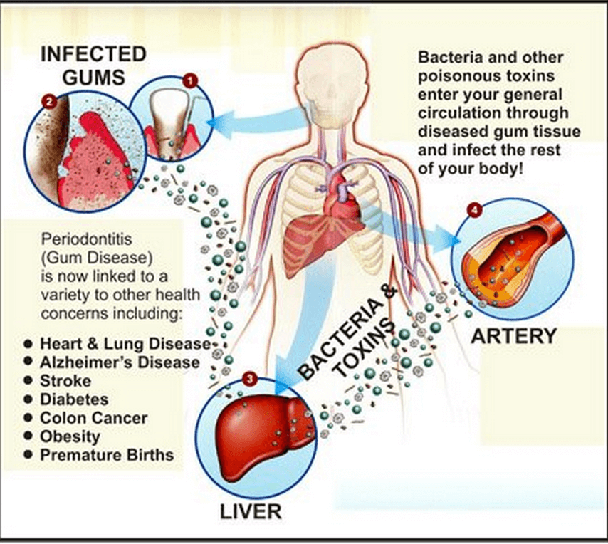 How Gum Disease Impacts Your Health